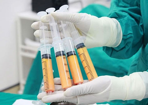 Cấy mỡ tự thân